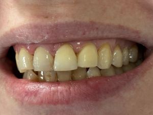 Dental Reimplant Trauma 3.jpg