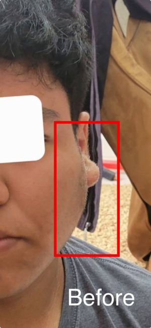 Case study parotitis mumps cur 1.jpg