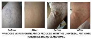 Varicose Veins CDS DMSO 10Days.jpg