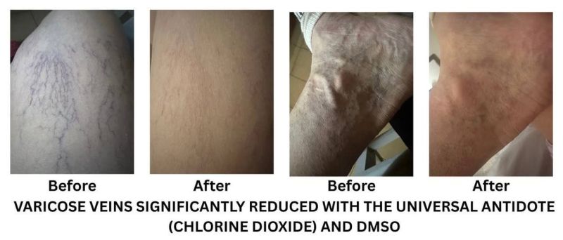 File:Varicose Veins CDS DMSO 10Days.jpg