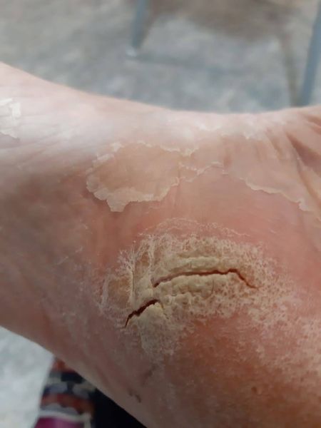 File:Wounds CDS Protocol D 08.jpg