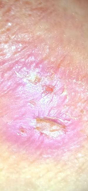 Case study diabetic decubitus 2.jpg