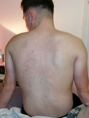 Case study pityriasis versicol 1.jpg