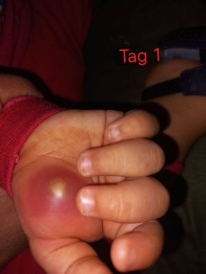 Case study toddler hand infect 2.jpg