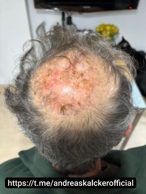 Dr Hernan Squamous Cell Cancer 02.jpg