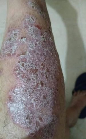 Psoriasis 15Years CD S 02.jpg
