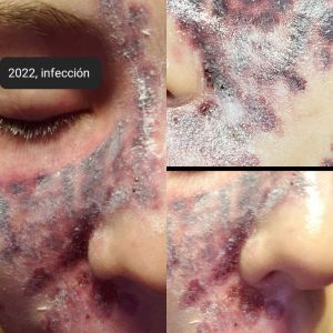 Case study hemangioma laser re 1.jpg
