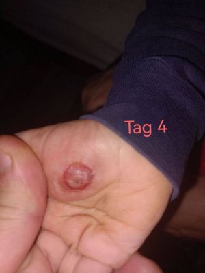 Case study toddler hand infect 5.jpg