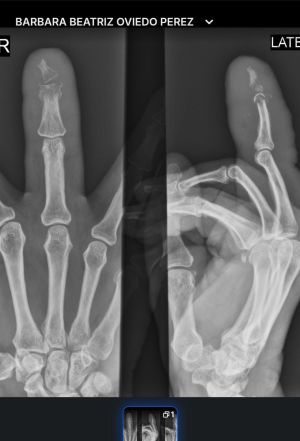 DiabeticFinger Process 13.jpg