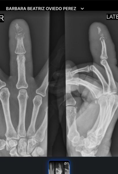 File:DiabeticFinger Process 13.jpg