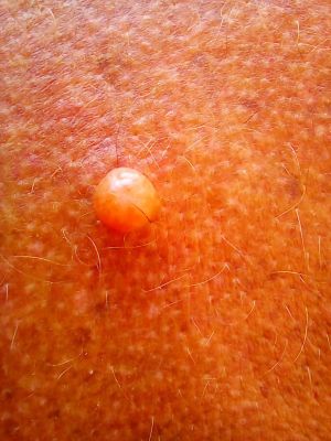 Basal Cell Carcinoma Before 01.jpg