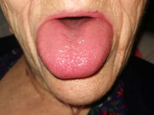Elderly Tongue Glossitis Before.jpg