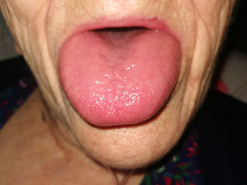 File:Elderly Tongue Glossitis Before.jpg