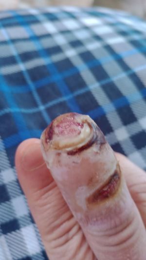 DiabeticFinger Process 10.jpg