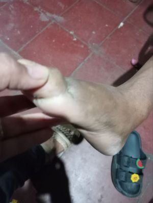 Case study gangrene in foot re 2.jpg