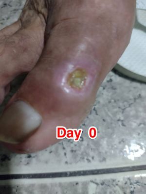 Case study chronic venous ulce 1.jpg