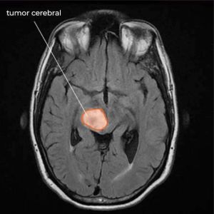Brain Tumor 72yo CDS DMSO.jpg