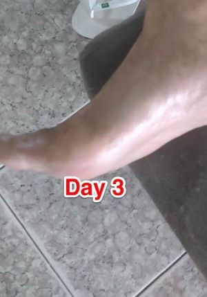 Case study chronic venous ulce 4.jpg