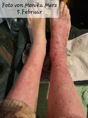 Cousin Insect Bite img b0d036b480e6.jpg