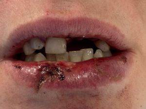 Dental Reimplant Trauma 11.jpg