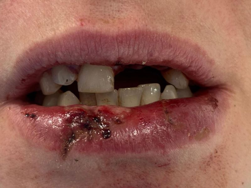 File:Dental Reimplant Trauma 11.jpg