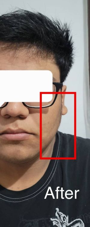 Case study parotitis mumps cur 2.jpg