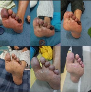 Arterial Thrombosis CDS Topical May June 2025.jpg