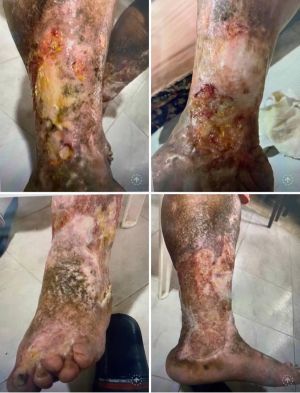 Post Thrombotic 76yo 01.jpg