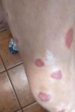 Case study brown recluse spide 2.jpg