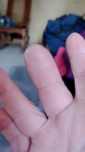 DiabeticFinger After 06.jpg