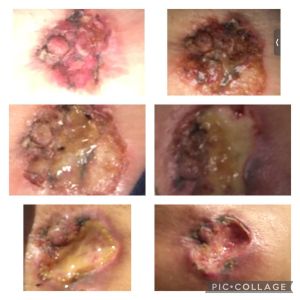 Case study breast cancer disin 1.jpg