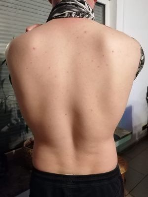 Case study pityriasis versicol 2.jpg