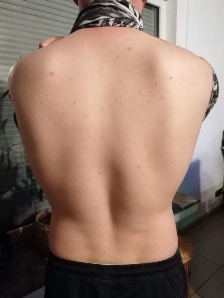 File:Case study pityriasis versicol 2.jpg