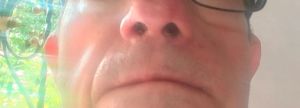 Nasal Tumor Benign CDS DMSO 02.jpg