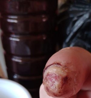 DiabeticFinger Process 03.jpg