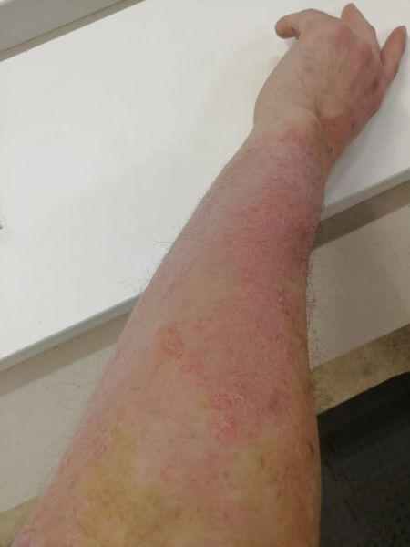 File:Neurodermatitis CDL Jan 2026.jpg