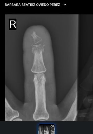 DiabeticFinger Process 12.jpg