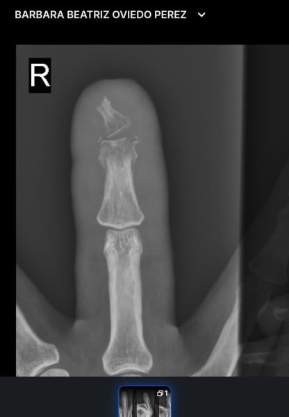 File:DiabeticFinger Process 12.jpg