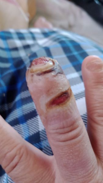 File:DiabeticFinger Process 09.jpg