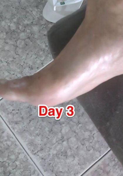 File:Case study non-healing chronic 4.jpg