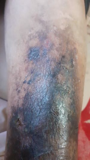 Varicose Ulcers Advanced 01.jpg