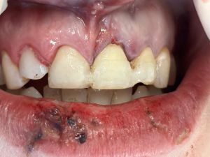 Dental Reimplant Trauma 7.jpg