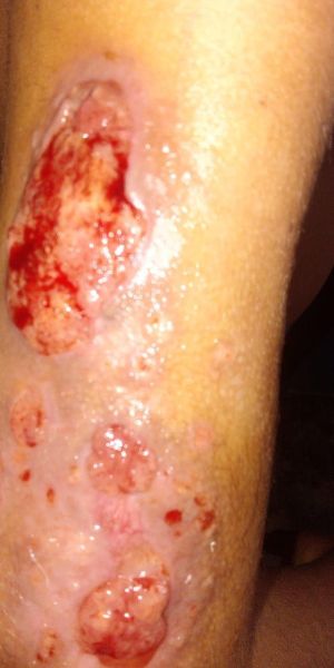 Case study childs burned arm h 3.jpg