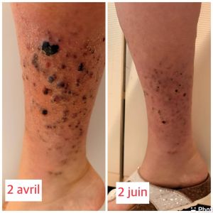 Testimonial Metastatic Nodular Melanoma Treated with Global 1.jpg