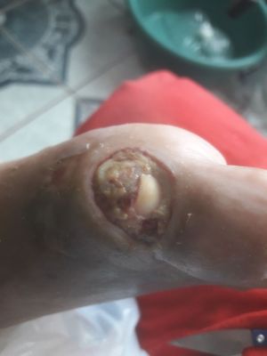 Case study gangrene in foot re 1.jpg