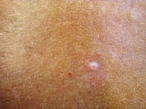 Basal Cell Carcinoma After 01.jpg