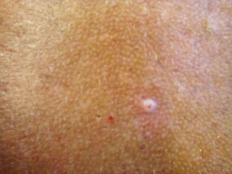 File:Basal Cell Carcinoma After 01.jpg