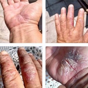 Dermatitis CDS DMSO Cured.jpg
