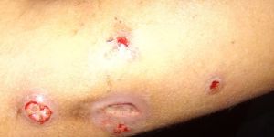 Case study childs burned arm h 4.jpg