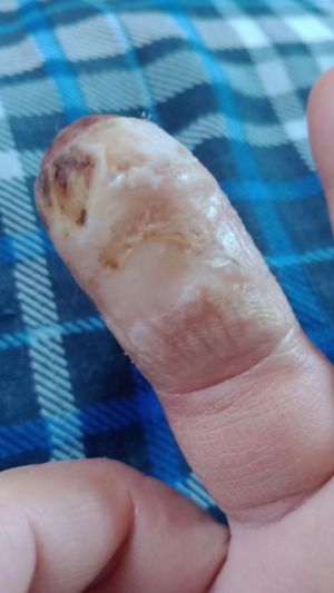 DiabeticFinger Process 07.jpg